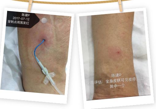 水胶体敷料不止用于压力性损伤 解锁皮肤外用敷料的无限可能
